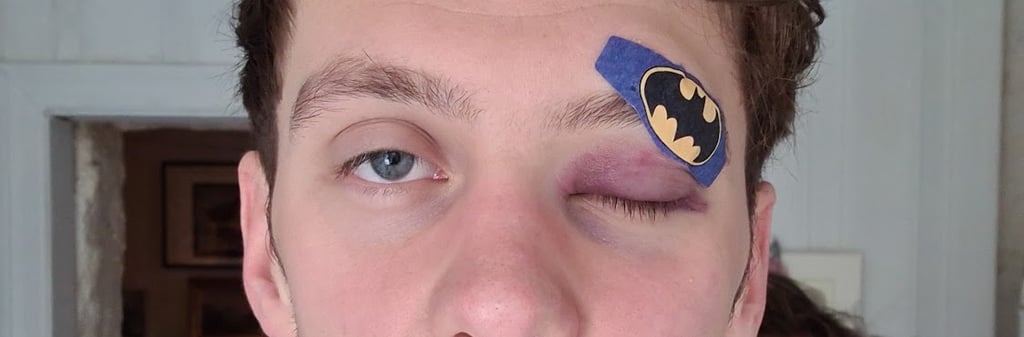 Ole Magnus Kinapel med blåveis og Batman-plaster over det ene øyet